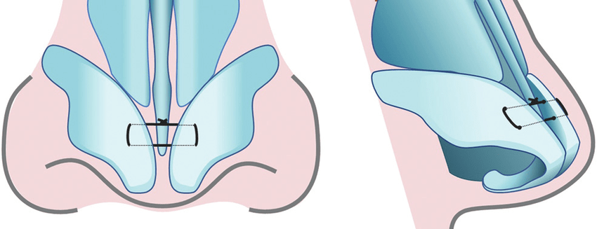 외측각연결봉합법(Lateral crura spanning suture)