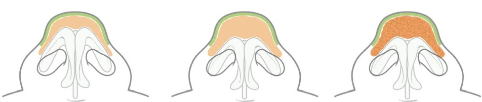  복코교정 - 코끝 지방제거