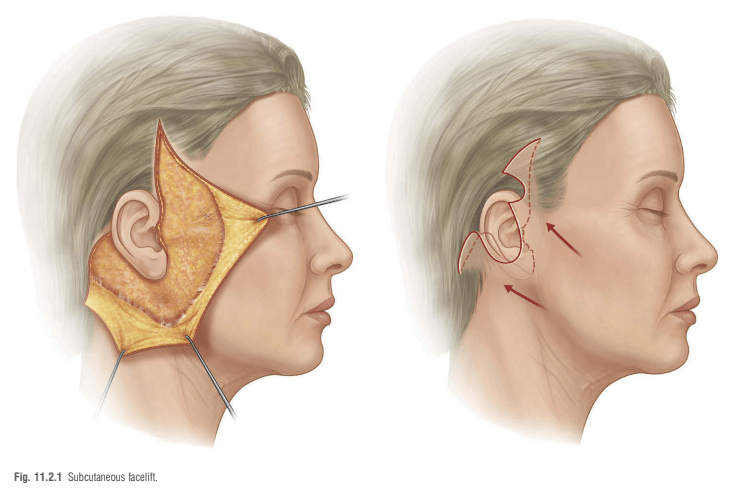 안면거상술-피부절개선